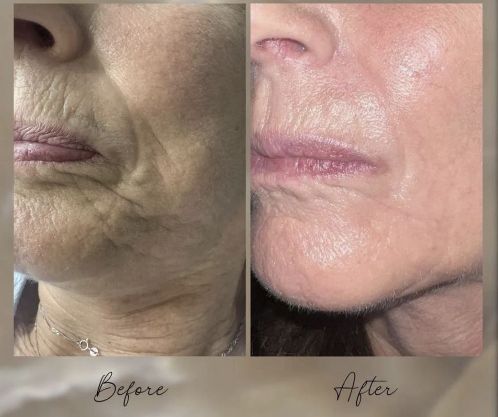Facial Inkless Revision before and after