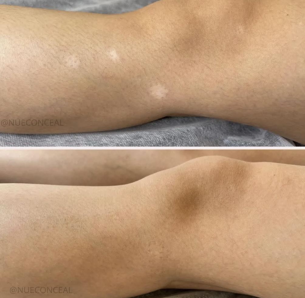 Scar Camouflage before and after