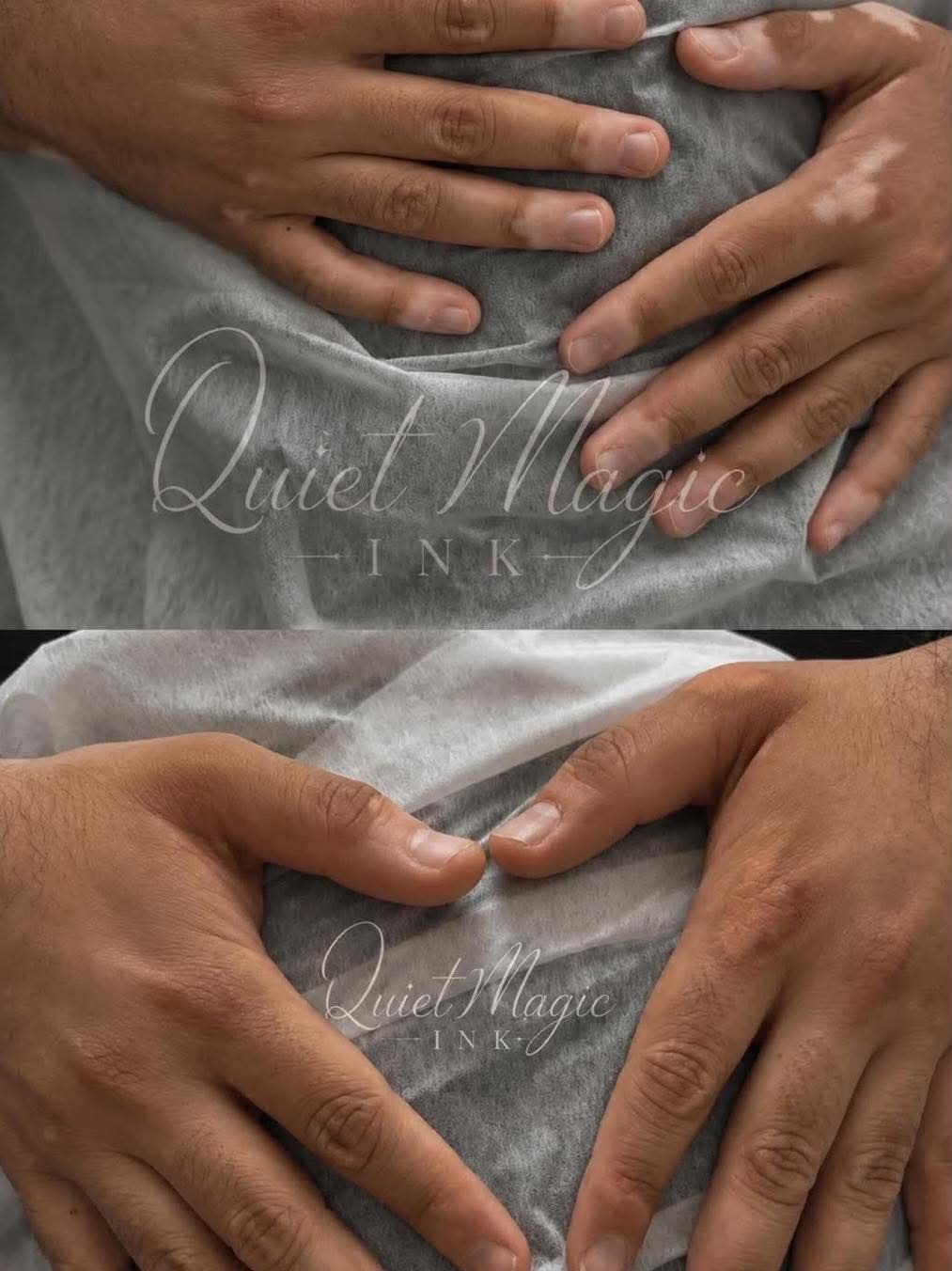 Vitiligo Camouflage before and after