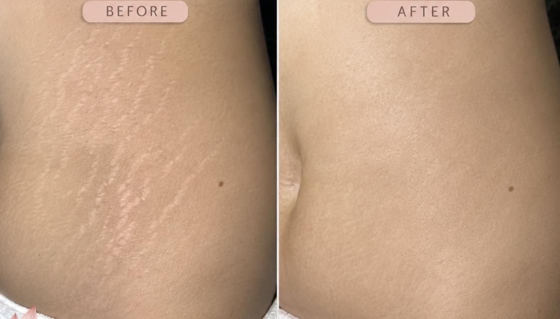 Stretch Mark Inkless Revision before and after