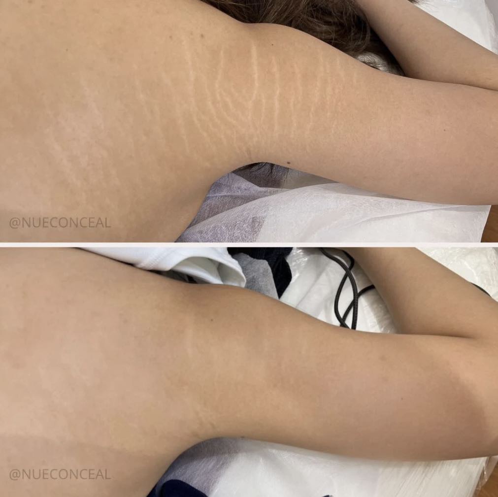 Stretch Mark Camouflage before and after