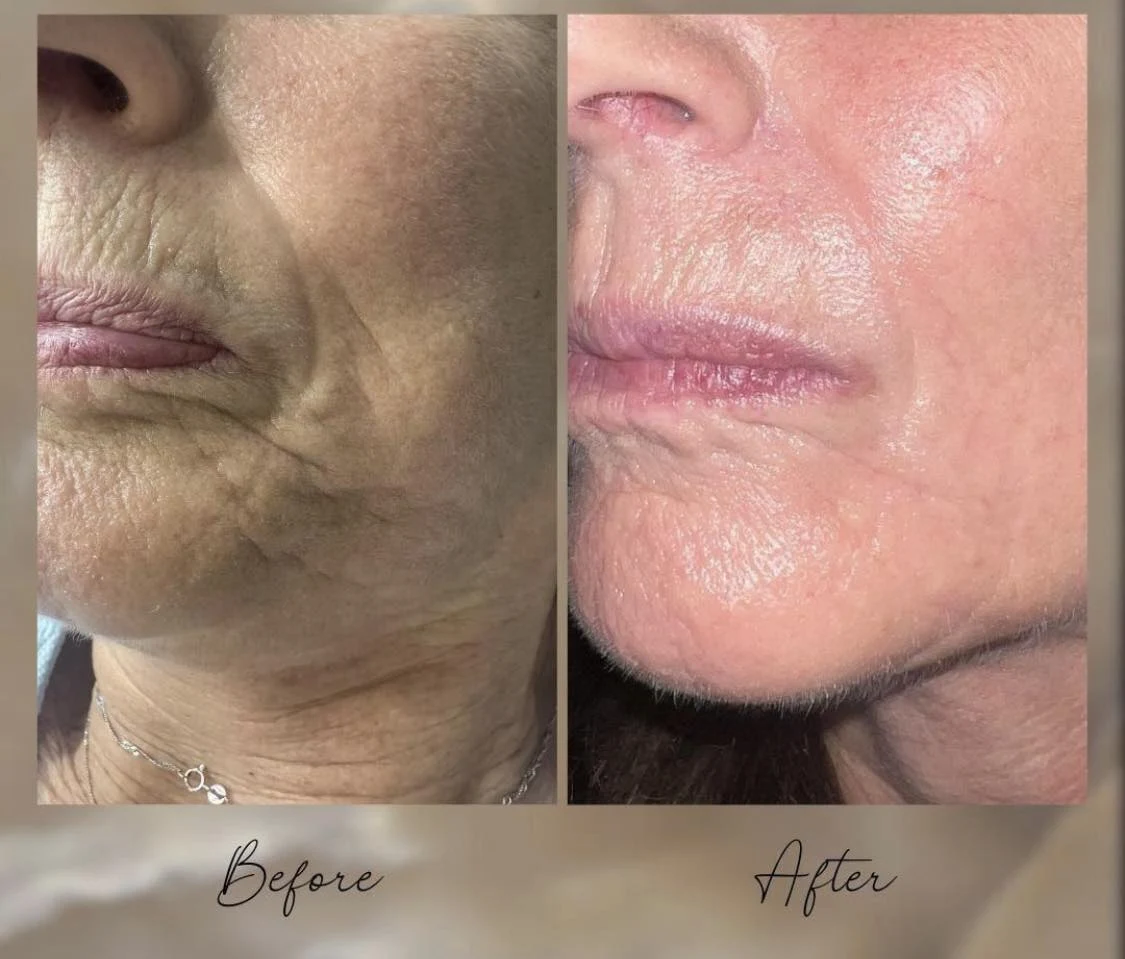 Facial scar before and after