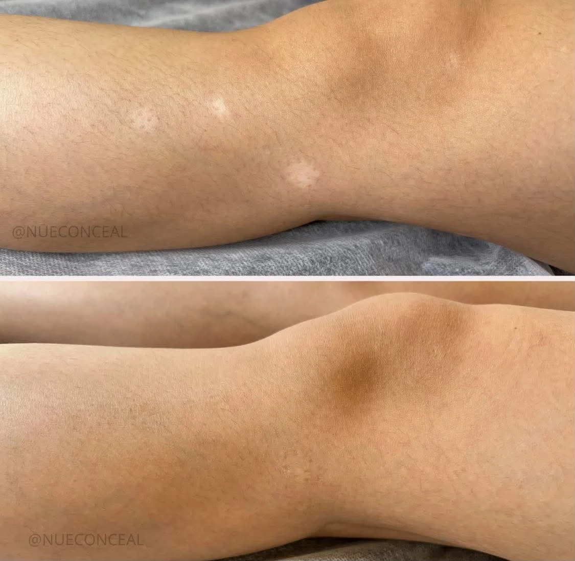 Leg scar before and after