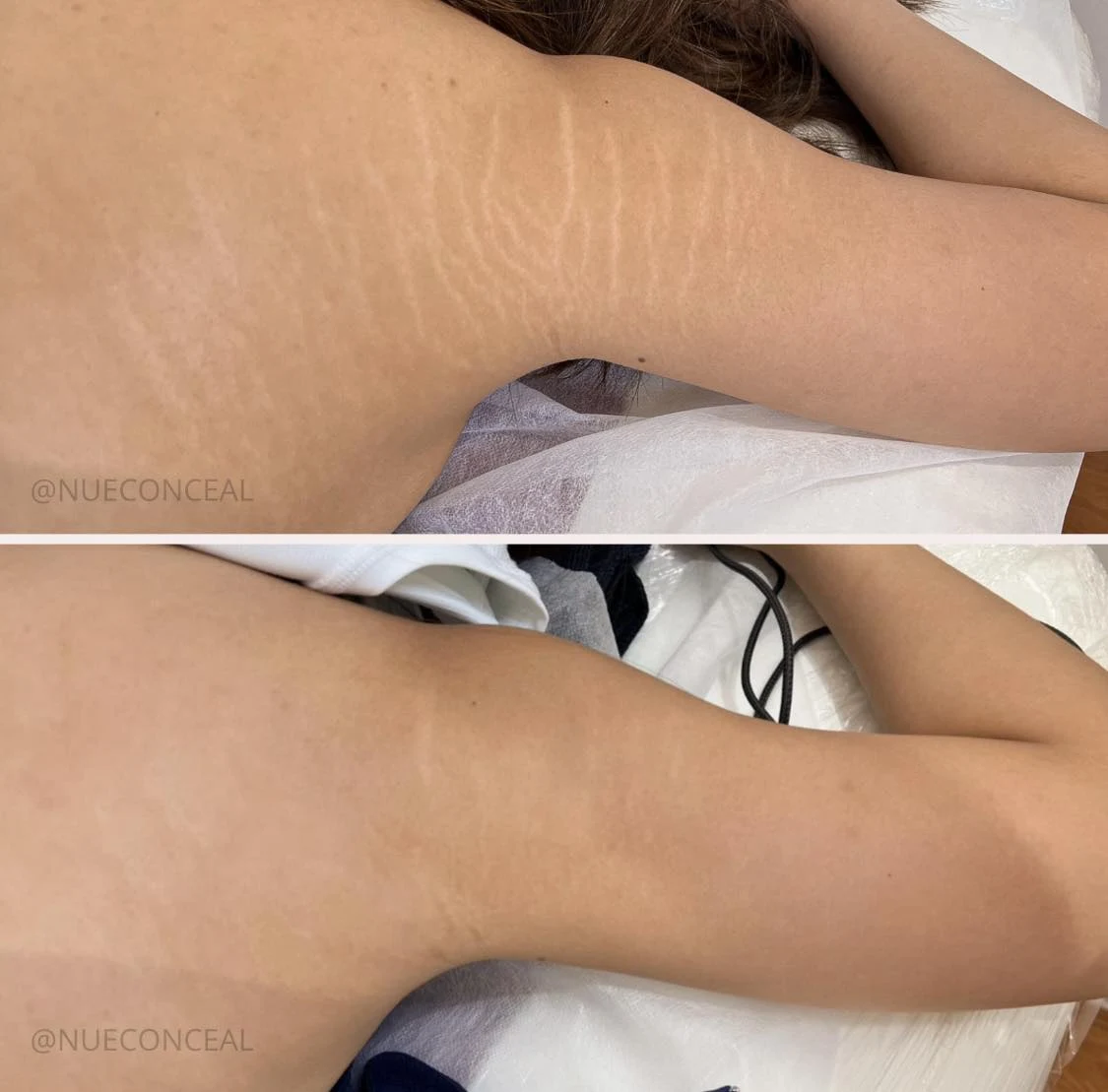 Stretch marks before and after